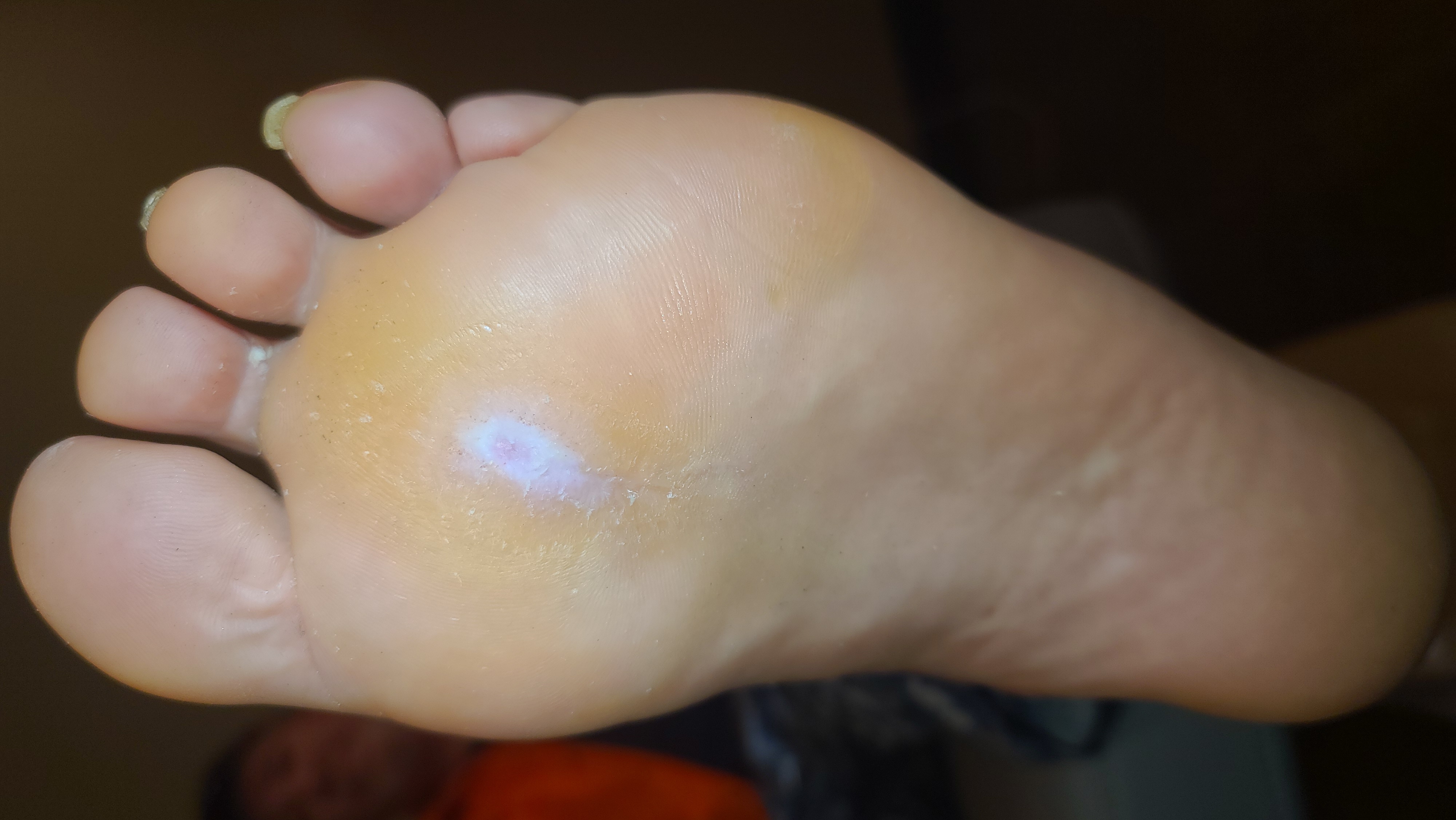 Diabetic foot ulcer after closure